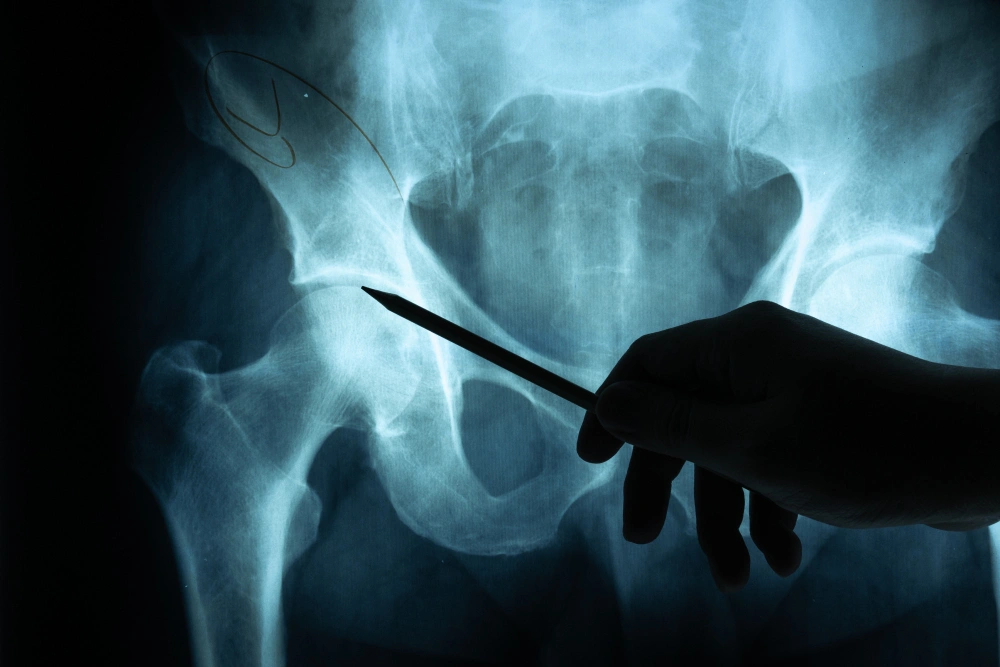 Surgical Treatment (For Unstable or Complex Fractures):