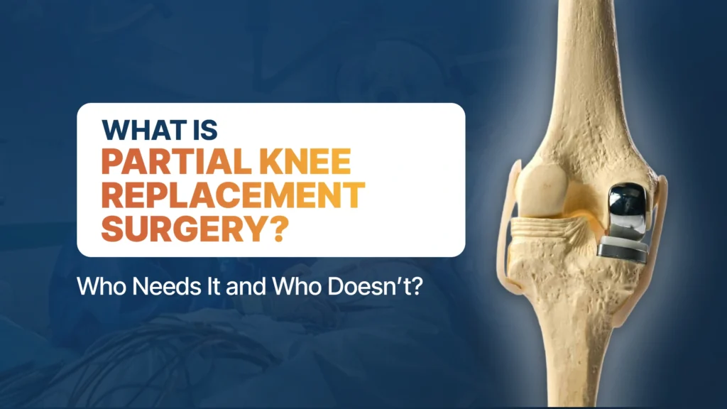 What Is Partial Knee Replacement Surgery? Who Needs It and Who Doesn’t?