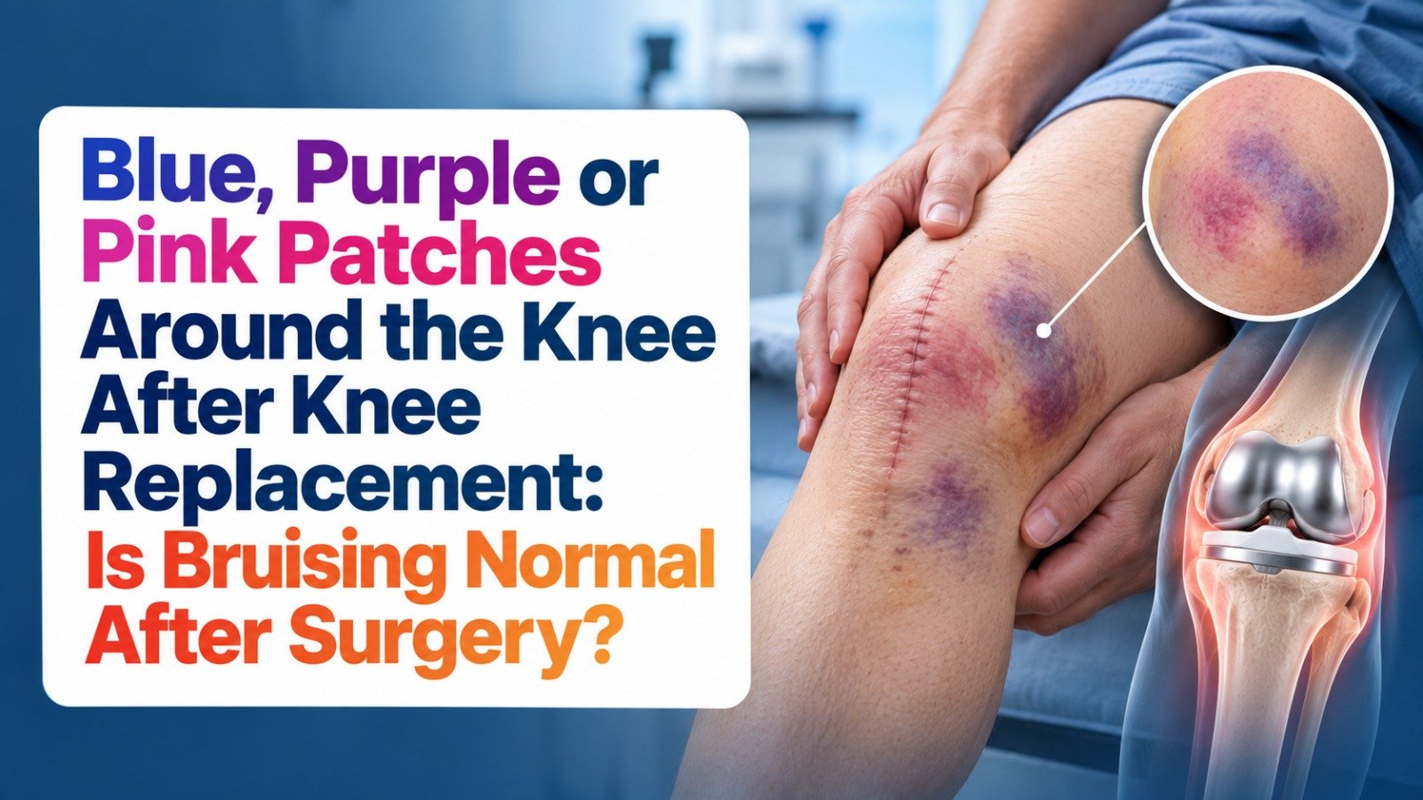 Blue, Purple or Pink Patches Around the Knee After Knee Replacement: Is Bruising Normal After Surgery?